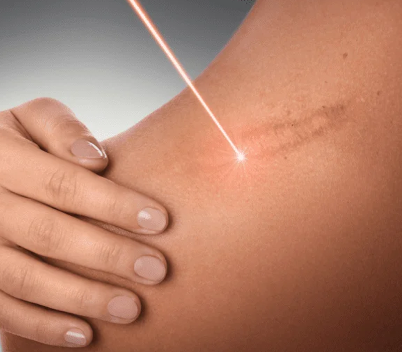 Laser treatment for skin