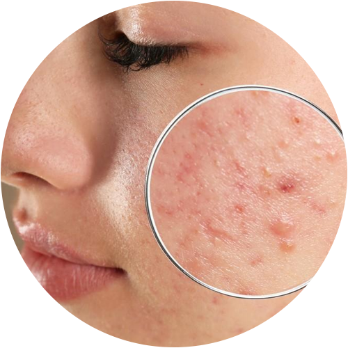 anti acne treatments