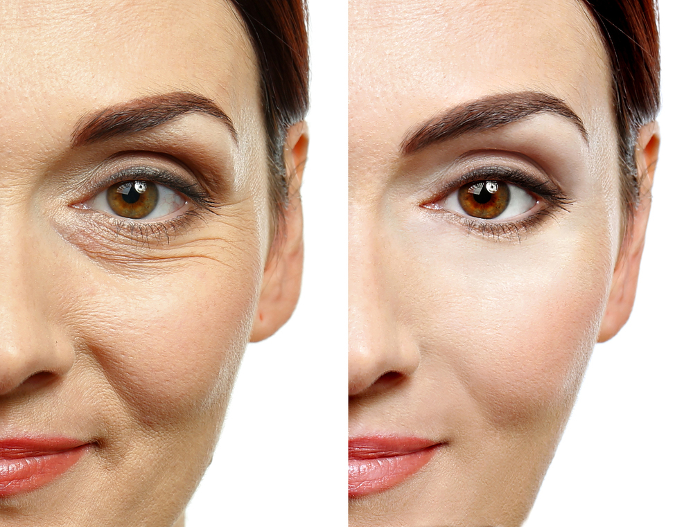 Best under eye treatment doctor