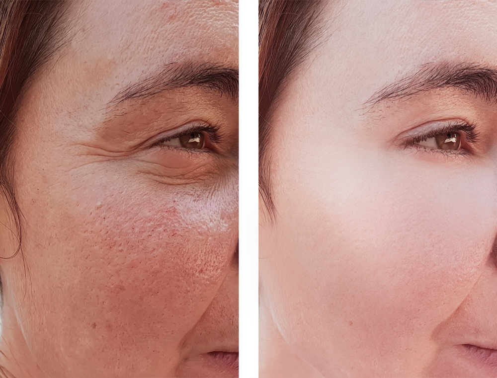 under eye treatment in Phagwara