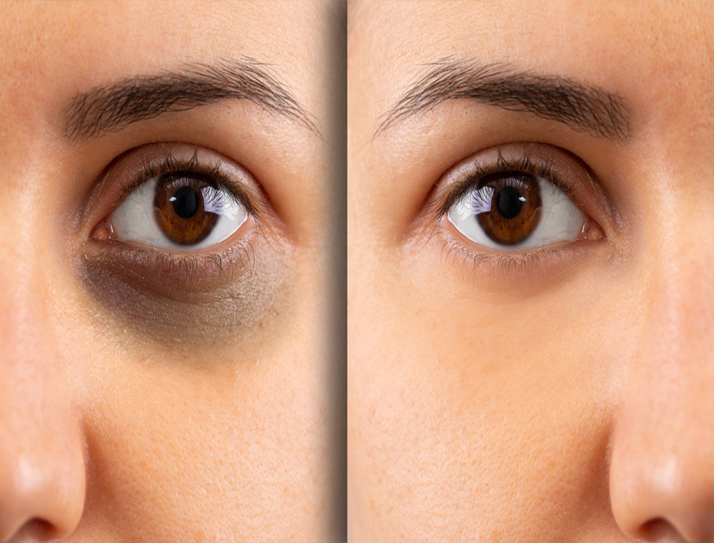 under eye treatment
