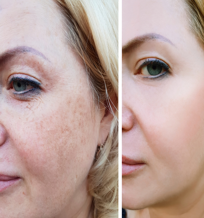 best anti pigmentation treatment in Punjab