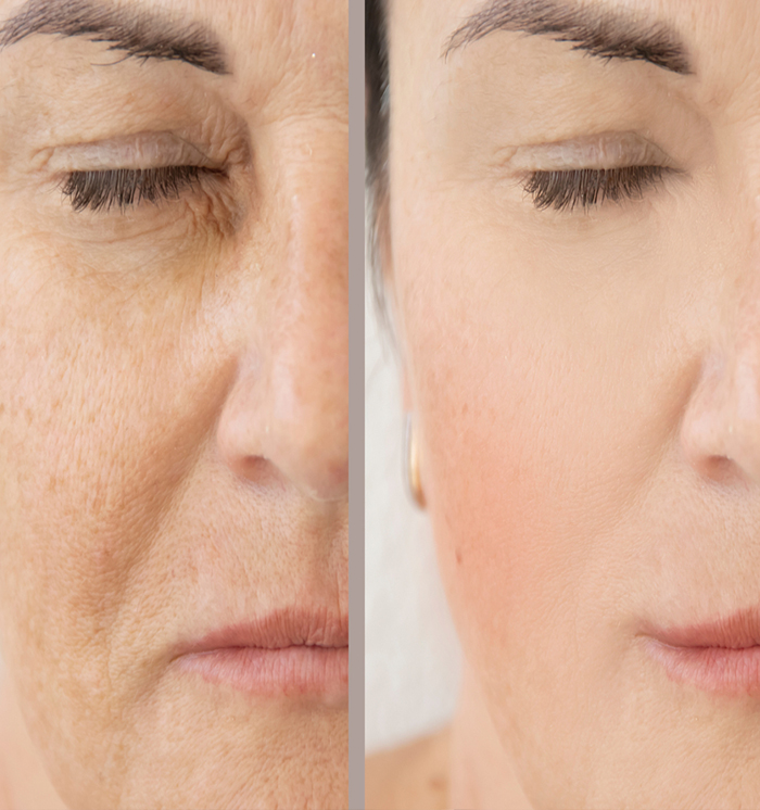 anti pigmentation treatment in Phagwara