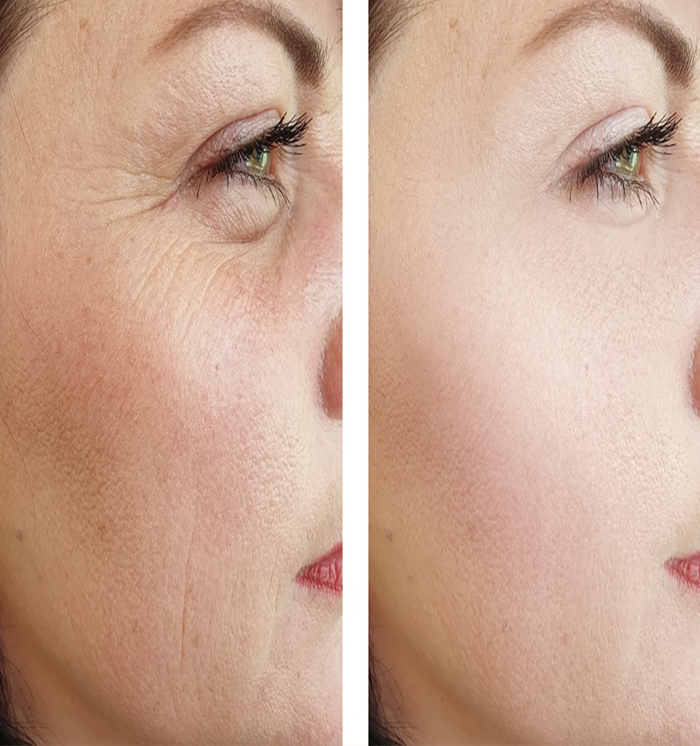 anti pigmentation treatment In Punjab