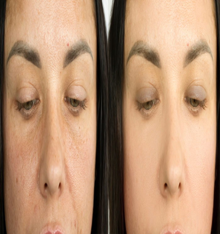 anti pigmentation treatment