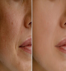 Best Pigmentation Clinic In Phagwara
