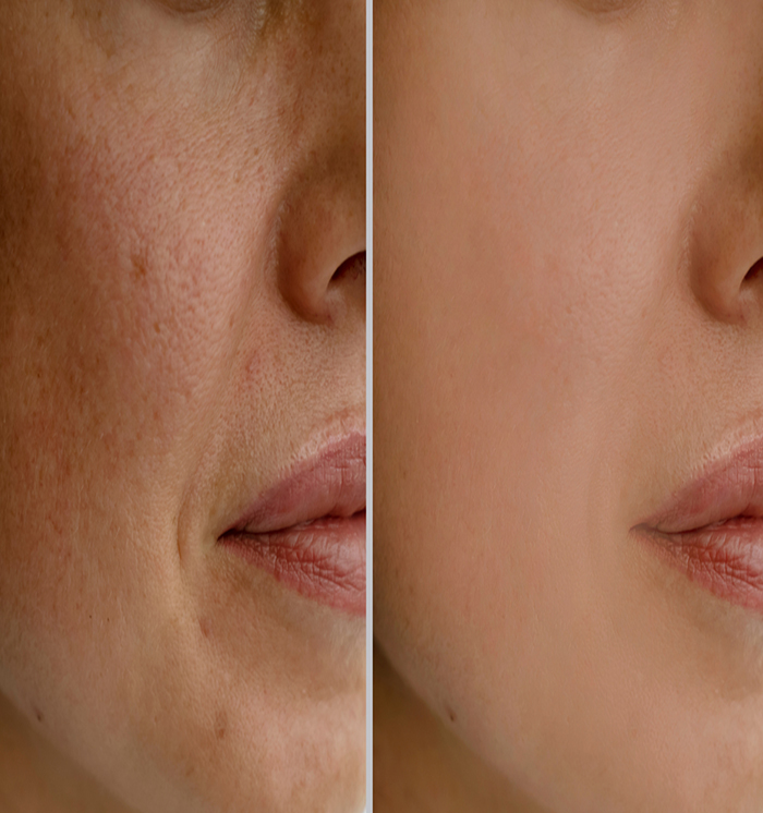 Best Pigmentation Clinic In Phagwara