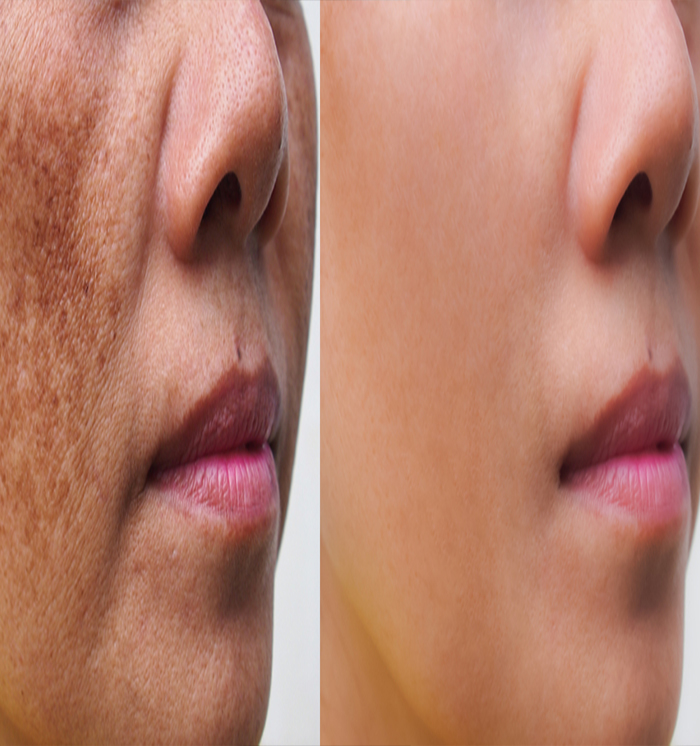 Best Pigmentation Hospital In Phagwara