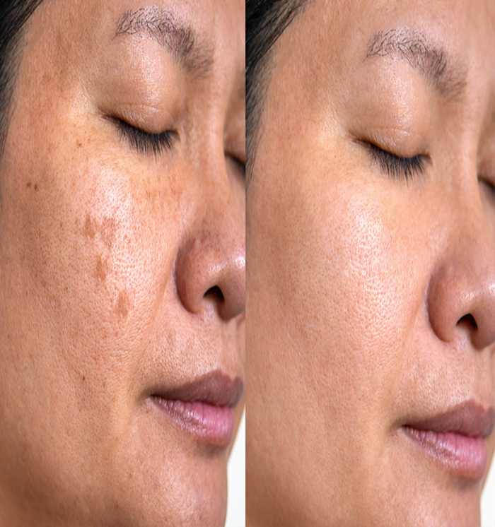 Best Pigmentation Hospital