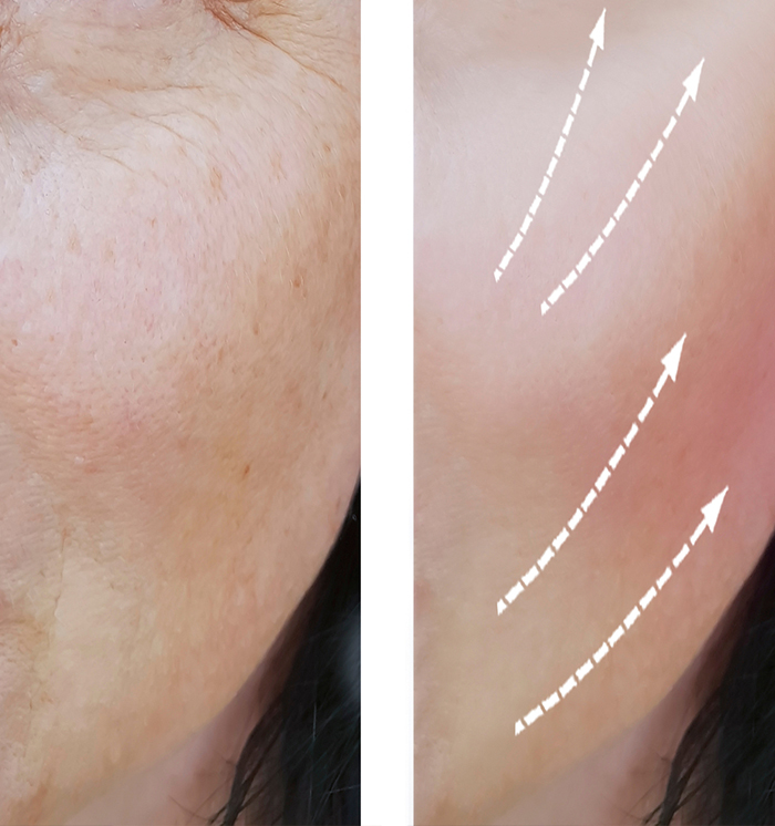 best anti pigmentation treatment in INDIA