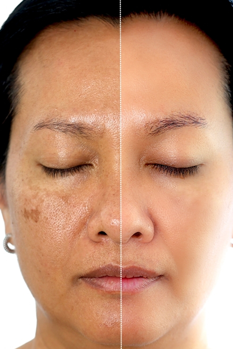 Pigmentation treatment in Phagwara